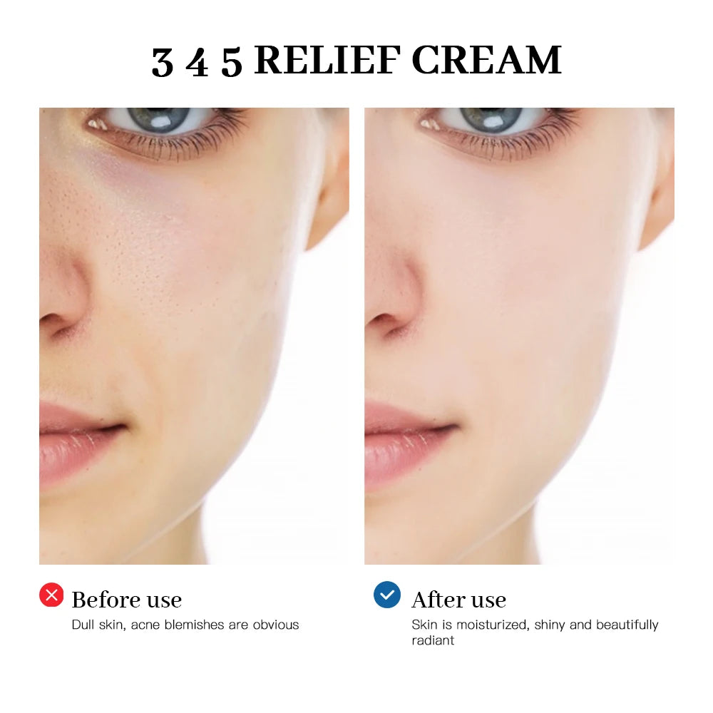 345 Relief Cream | Comprehensive Solution to Skin Problems | Anti-Sugar and Antioxidant Brightening Skin Improving Acne Marks